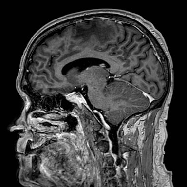 Brain metastases from lung cancer (Radiopaedia 83839-99028 Sagittal T1 C+ 36).jpg