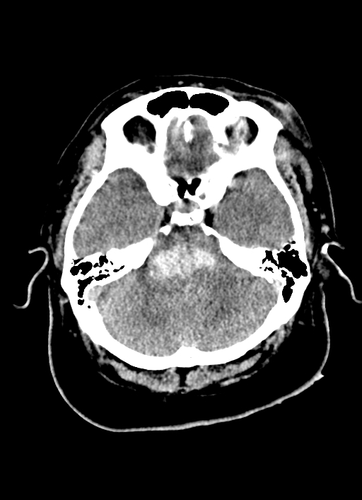 Brainstem hemorrhage (Radiopaedia 81294-94976 Axial non-contrast 45).jpg