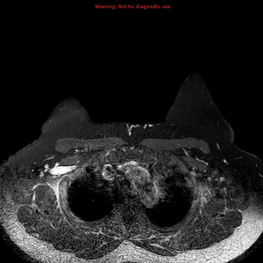 File:Breast carcinoma (multicentric multifocal in mammary Paget disease) (Radiopaedia 50966-56512 Axial T1 C+ fat sat 14).jpg