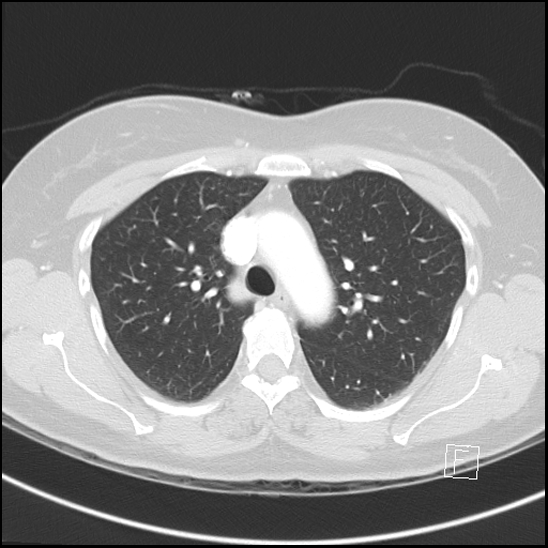 File:Breast metastases from renal cell cancer (Radiopaedia 79220-92225 Axial lung window 25).jpg