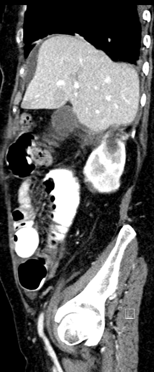 Broad ligament hernia (Radiopaedia 84802-100276 C 62).jpg