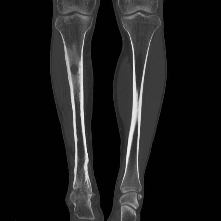Brodie abscess - tibia (Radiopaedia 66028-75204 Coronal bone window 27).jpg