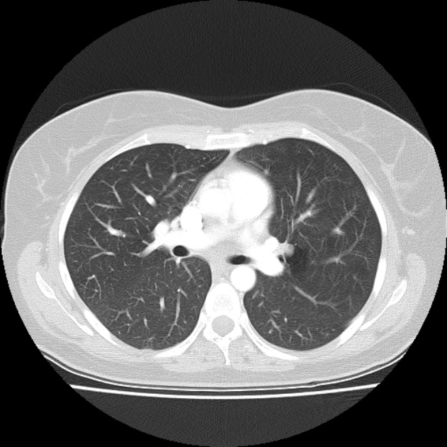 Bronchial atresia (Radiopaedia 22965-22992 Axial lung window 29).jpg