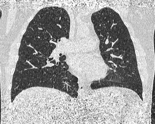 Bronchial atresia (Radiopaedia 58271-65417 Coronal lung window 26).jpg