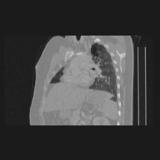 Bronchial atresia (Radiopaedia 60685-68439 Sagittal lung window 53).jpg