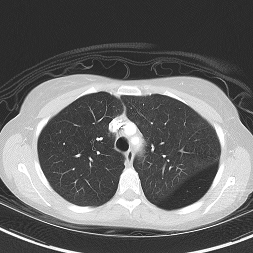 Bronchial atresia (Radiopaedia 73677-84470 Axial lung window 20).jpg