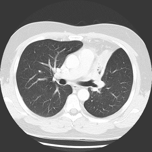 Bronchial carcinoid tumor (Radiopaedia 67377-76764 Axial lung window 29).jpg