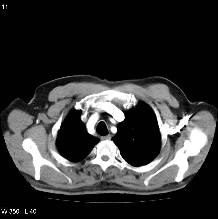 Bronchial carcinoid tumor with right lower lobe collapse (Radiopaedia 29060-29422 A 10).jpg