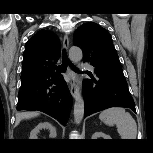 File:Bronchial stenosis - lung transplant (Radiopaedia 73133-83848 Coronal non-contrast 41).jpg