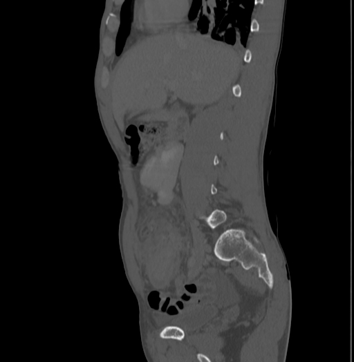 File:Bronchiectasis in Crohn disease (Radiopaedia 60311-67977 Sagittal bone window 83).jpg