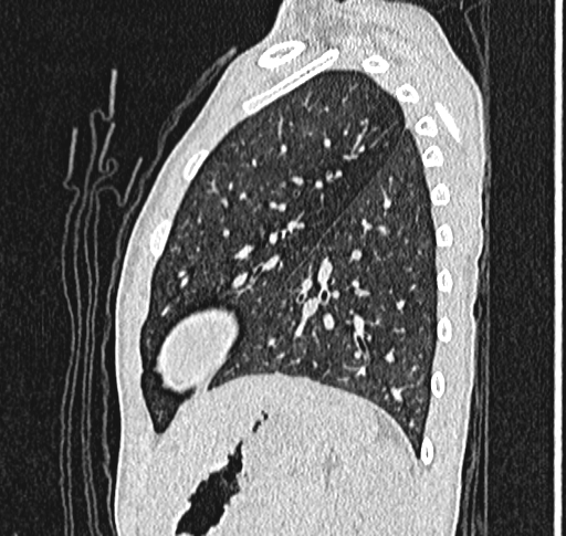 File:Bronchiolitis obliterans (Radiopaedia 71538-81897 Sagittal lung window 52).jpg