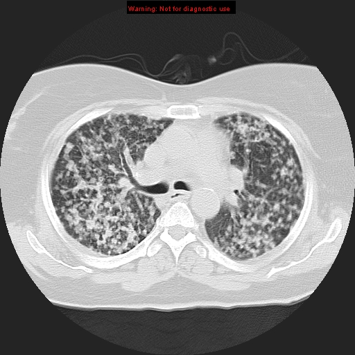 Bronchoalveolar carcinoma (Radiopaedia 13224-13233 Axial lung window 18).jpg