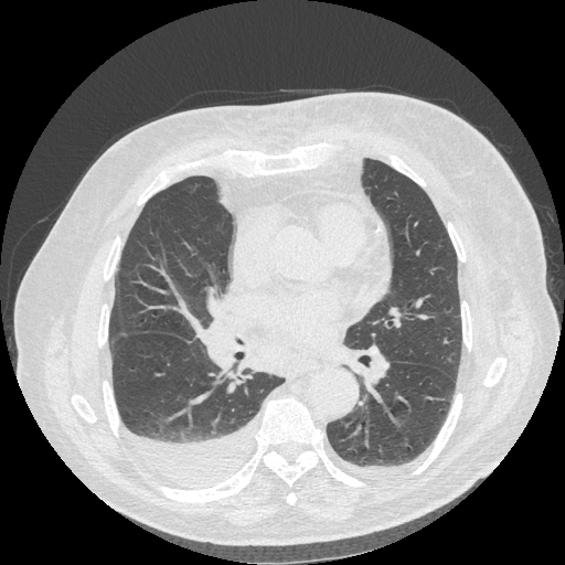 Bronchogenic carcinoma with metastatic lymphadenopathy (Radiopaedia 37671-39569 Axial lung window 31).jpg