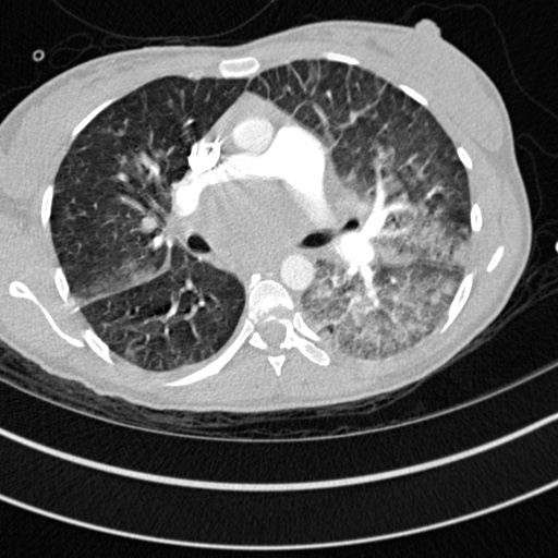 Bronchogenic cyst (Radiopaedia 77801-90071 Axial lung window 27).jpg