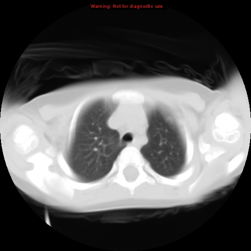 File:Bronchogenic cyst (Radiopaedia 9372-10063 Axial lung window 4).jpg