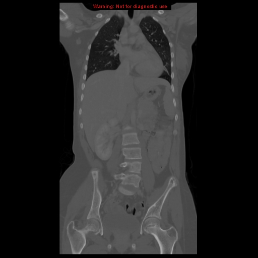 File:Brown tumor (Radiopaedia 12318-12596 D 35).jpg