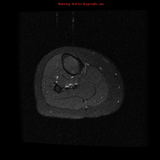 File:Brown tumor (Radiopaedia 12318-12597 Axial T1 C+ fat sat 21).jpg