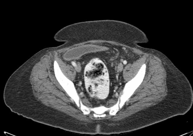 File:Brown tumors compressing the spinal cord (Radiopaedia 68442-77988 E 104).jpg