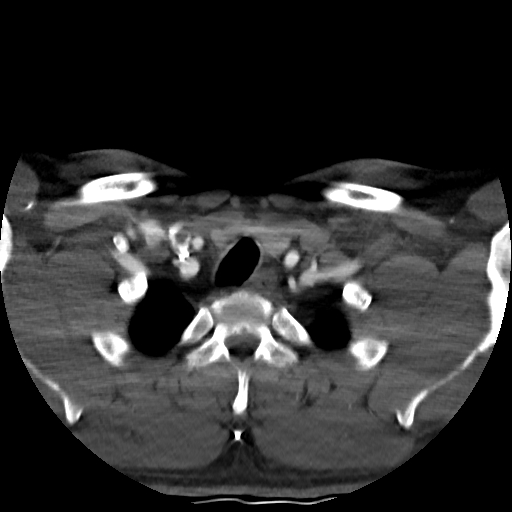 Buccal fat pad arteriovenous malformation (Radiopaedia 70936-81144 A 96).jpg