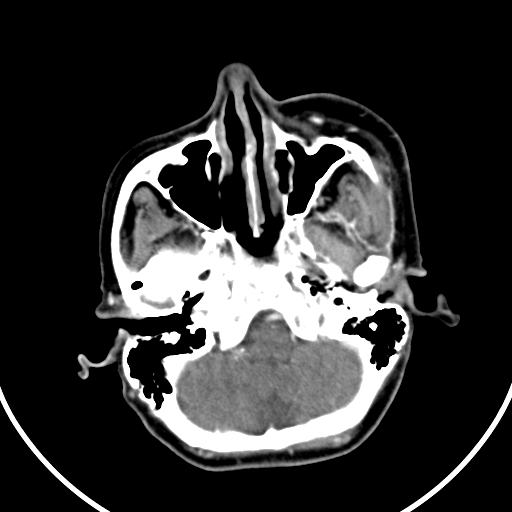 File:Buccal squamous cell carcinoma (Radiopaedia 8520-9346 A 6).jpg