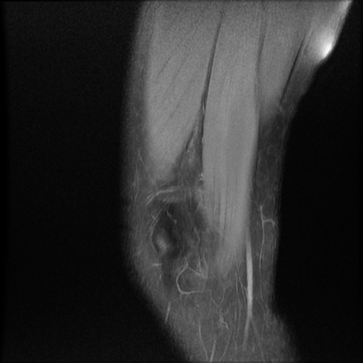 File:Bucket-handle meniscus tear (Radiopaedia 65700-74809 Sagittal PD fat sat 3).jpg