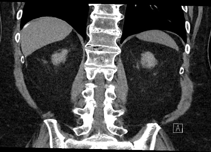 Buried bumper syndrome - gastrostomy tube (Radiopaedia 63843-72577 Coronal Inject 102).jpg