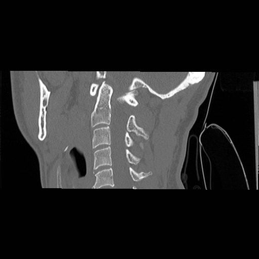 File:C1-C2 "subluxation" - normal cervical anatomy at maximum head rotation (Radiopaedia 42483-45607 C 36).jpg