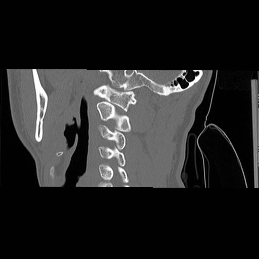 C1-C2 "subluxation" - normal cervical anatomy at maximum head rotation (Radiopaedia 42483-45607 C 44).jpg
