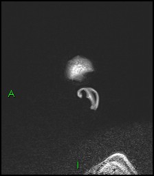 CNS manifestations of NF1 - optic pathway glioma, neurofibroma, dural ectasia (Radiopaedia 37874-39805 Sagittal FLAIR 1).jpg