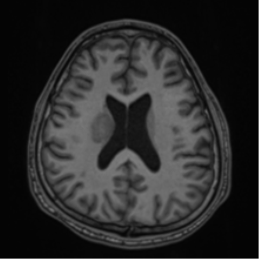 CNS vasculitis (Radiopaedia 55715-62263 Axial T1 50).png