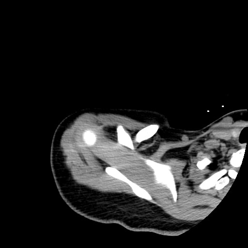 Calcific tendinitis of the infraspinatus tendon (Radiopaedia 87256-103539 B 18).jpg
