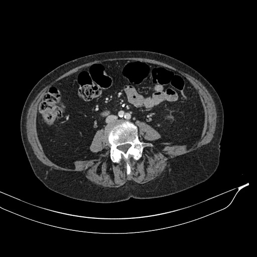 Calcified adrenal glands and Spigelian hernia (Radiopaedia 49741-54988 A 125).jpg