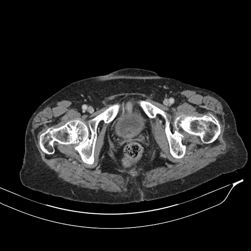 Calcified adrenal glands and Spigelian hernia (Radiopaedia 49741-54988 A 241).jpg