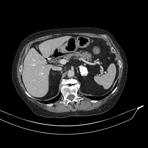 Calcified adrenal glands and Spigelian hernia (Radiopaedia 49741-54988 A 59).jpg