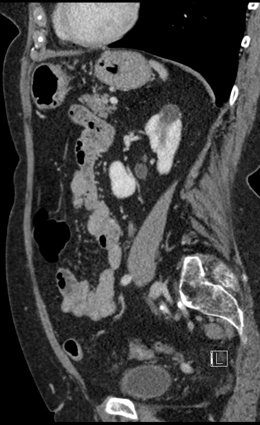 Calcified adrenal glands and Spigelian hernia (Radiopaedia 49741-54988 C 56).jpg