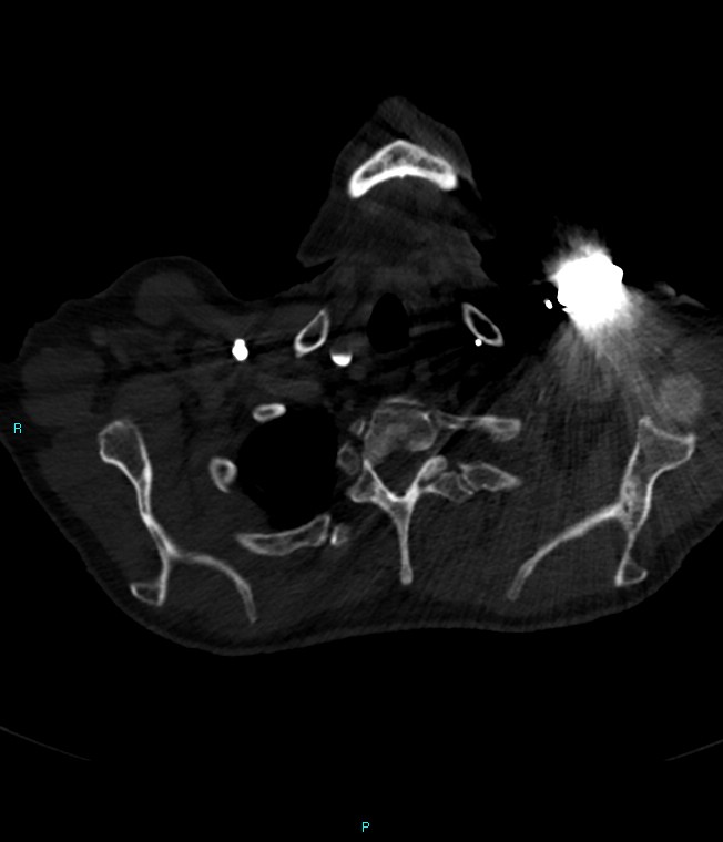 Calcified cerebral emboli from left ventricular thrombus (Radiopaedia 84420-99760 Axial bone window 5).jpg