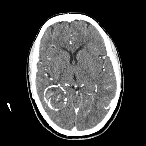 Calcified cerebral hydatid cyst (Radiopaedia 65603-74717 Axial with contrast 35).jpg