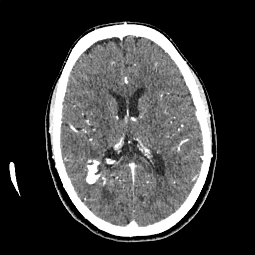 Calcified cerebral hydatid cyst (Radiopaedia 65603-74717 Axial with contrast 43).jpg
