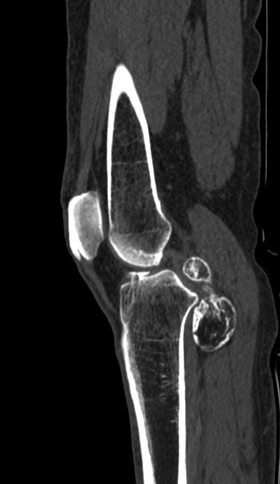 Calcified hematoma - popliteal fossa (Radiopaedia 63938-72763 Sagittal bone window 32).jpg