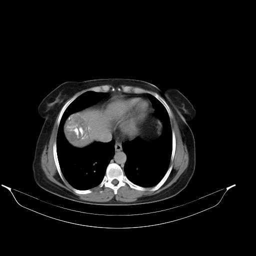 File:Calcified hydatid cyst of the liver (Radiopaedia 21212-21112 Axial C+ delayed 8).jpg