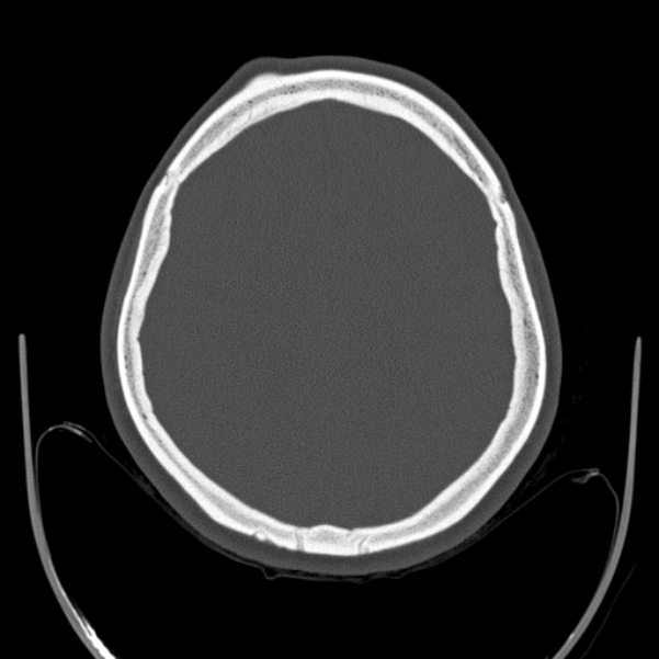 Calvarial osteoma (Radiopaedia 36520-38079 Axial bone window 76).jpg