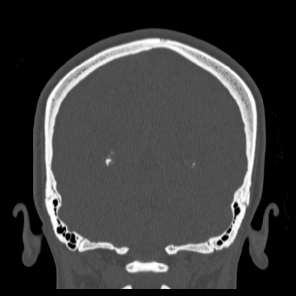 Calvarial osteoma (Radiopaedia 36520-38079 C 68).jpg