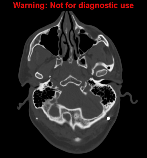 Calvarial thickening from chronic shunting (Radiopaedia 60079-67637 Axial bone window 23).jpg