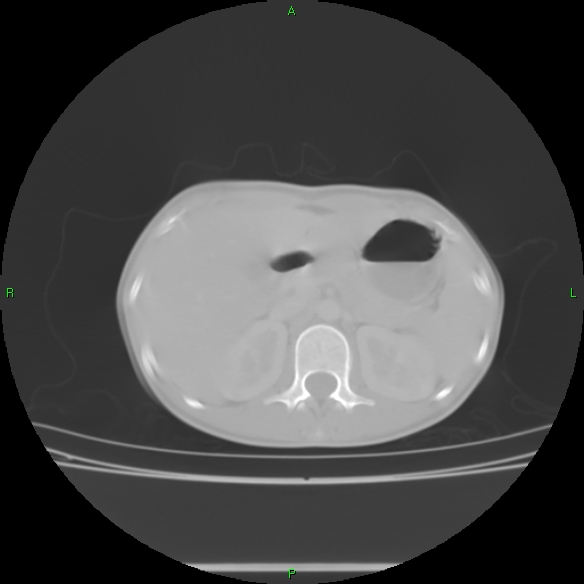 File:Cannon ball metastases - synovial sarcoma (Radiopaedia 26135-26271 Axial lung window 39).jpg
