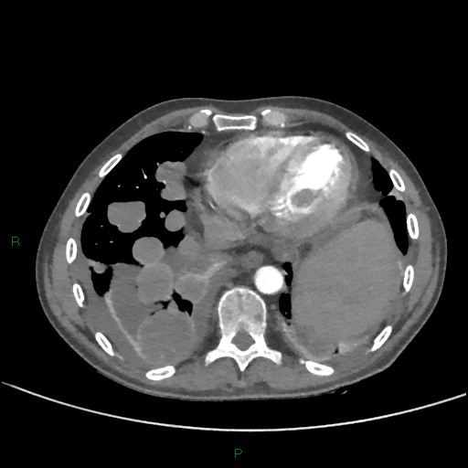 Cannonball metastases (Radiopaedia 82110-96150 Axial C+ CTPA 242).jpg