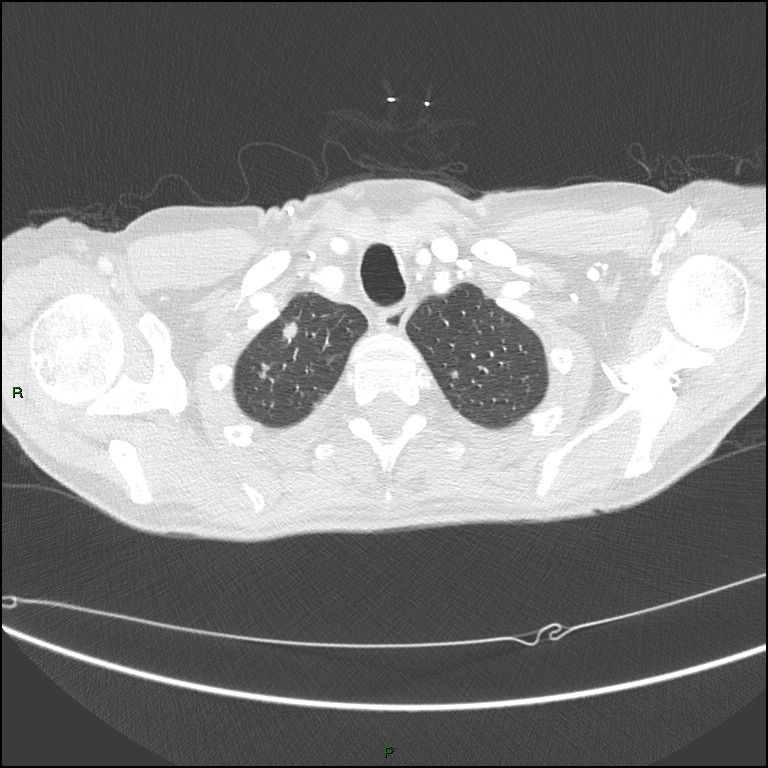 Cannonball metastases (Radiopaedia 82110-96150 Axial lung window 30).jpg