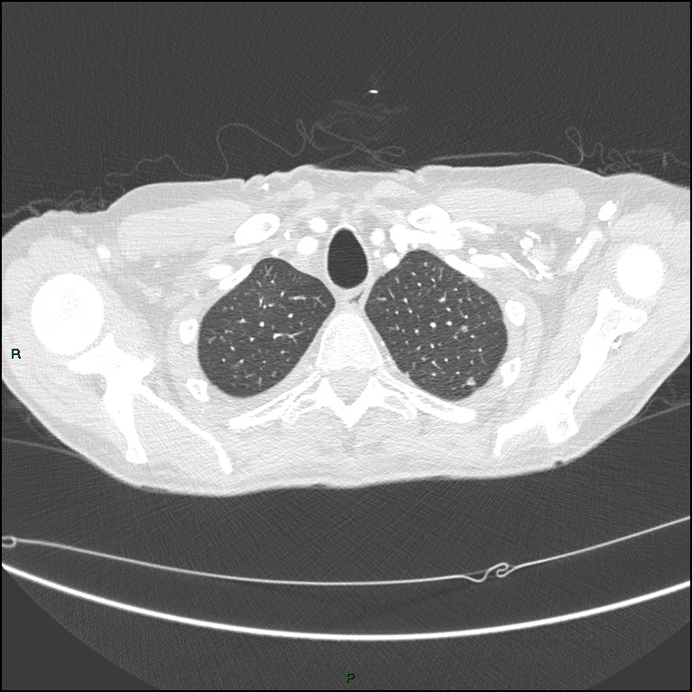 Cannonball metastases (Radiopaedia 82110-96150 Axial lung window 35).jpg
