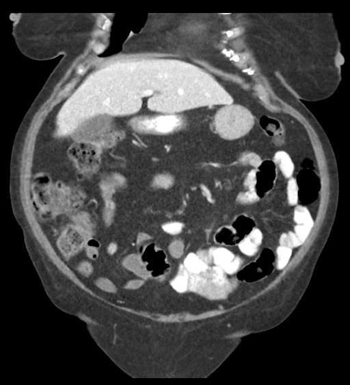 File:Cannonball metastases from endometrial cancer (Radiopaedia 42003-45031 F 23).png
