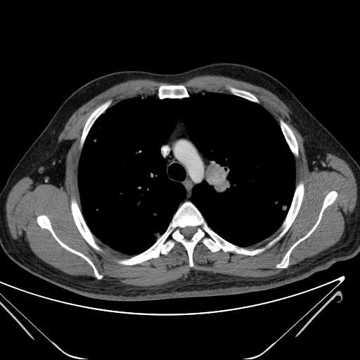 File:Cannonball pulmonary metastases (Radiopaedia 67684-77101 D 91).jpg