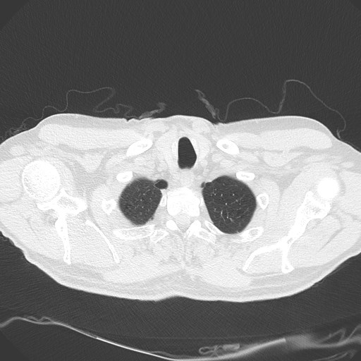 Caplan syndrome (Radiopaedia 56667-63530 Axial lung window 23).jpg